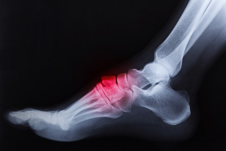 43469008_S_xray_foot_broken_right